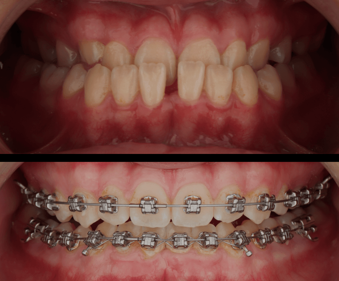 Ortodoncia con brackets