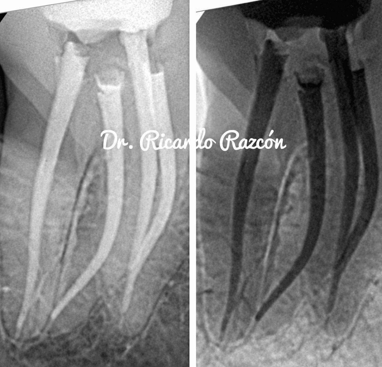 Endodoncia